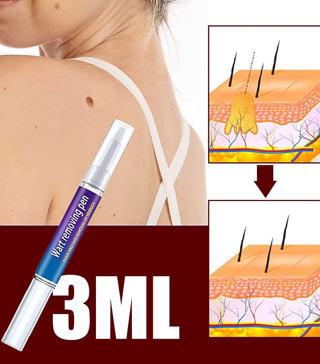 Advanced Herbal Wart Skin Tags Remover